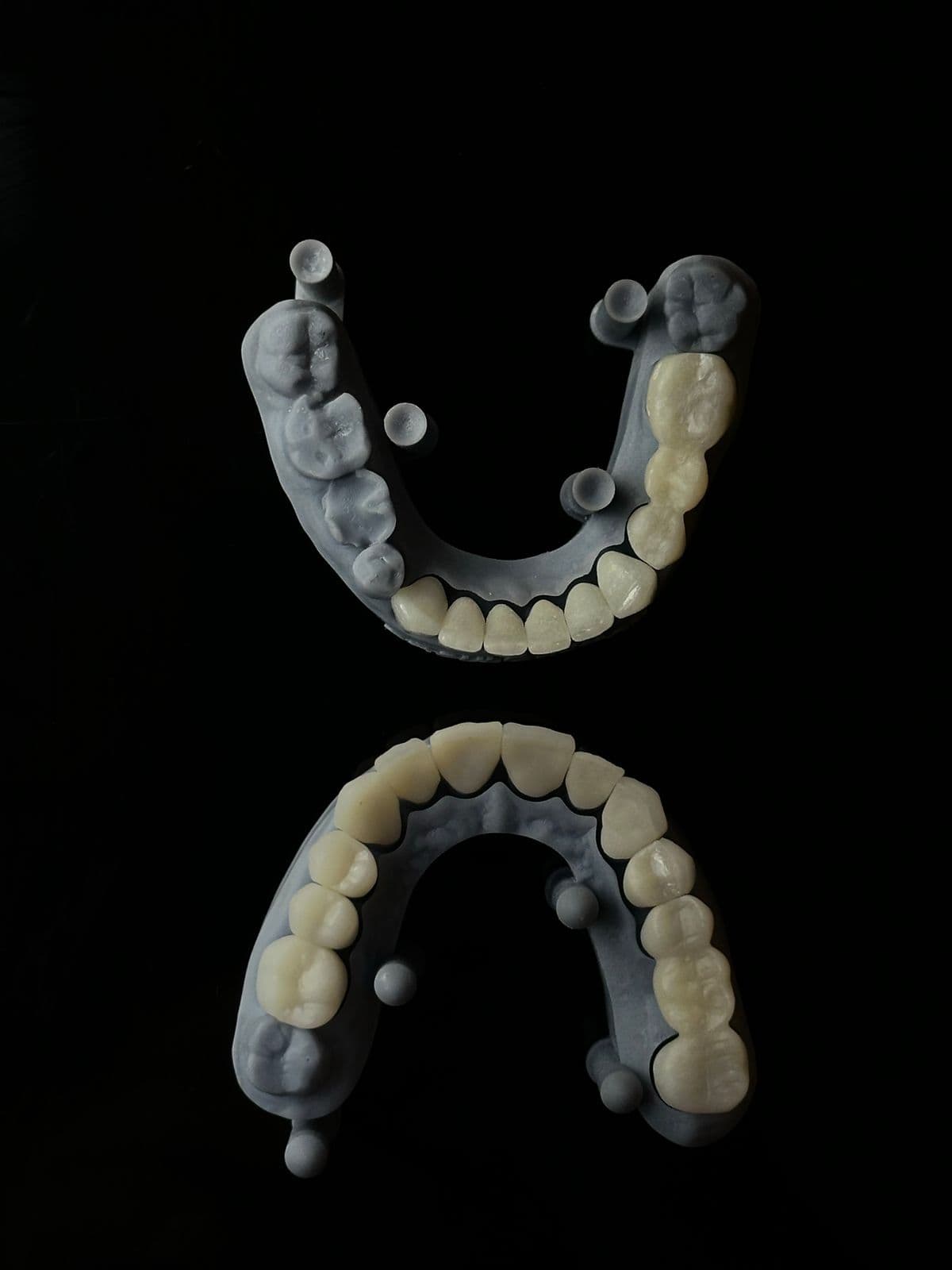 Implant All-on-4 / All-on-6 là gì? Phù hợp với ai?
