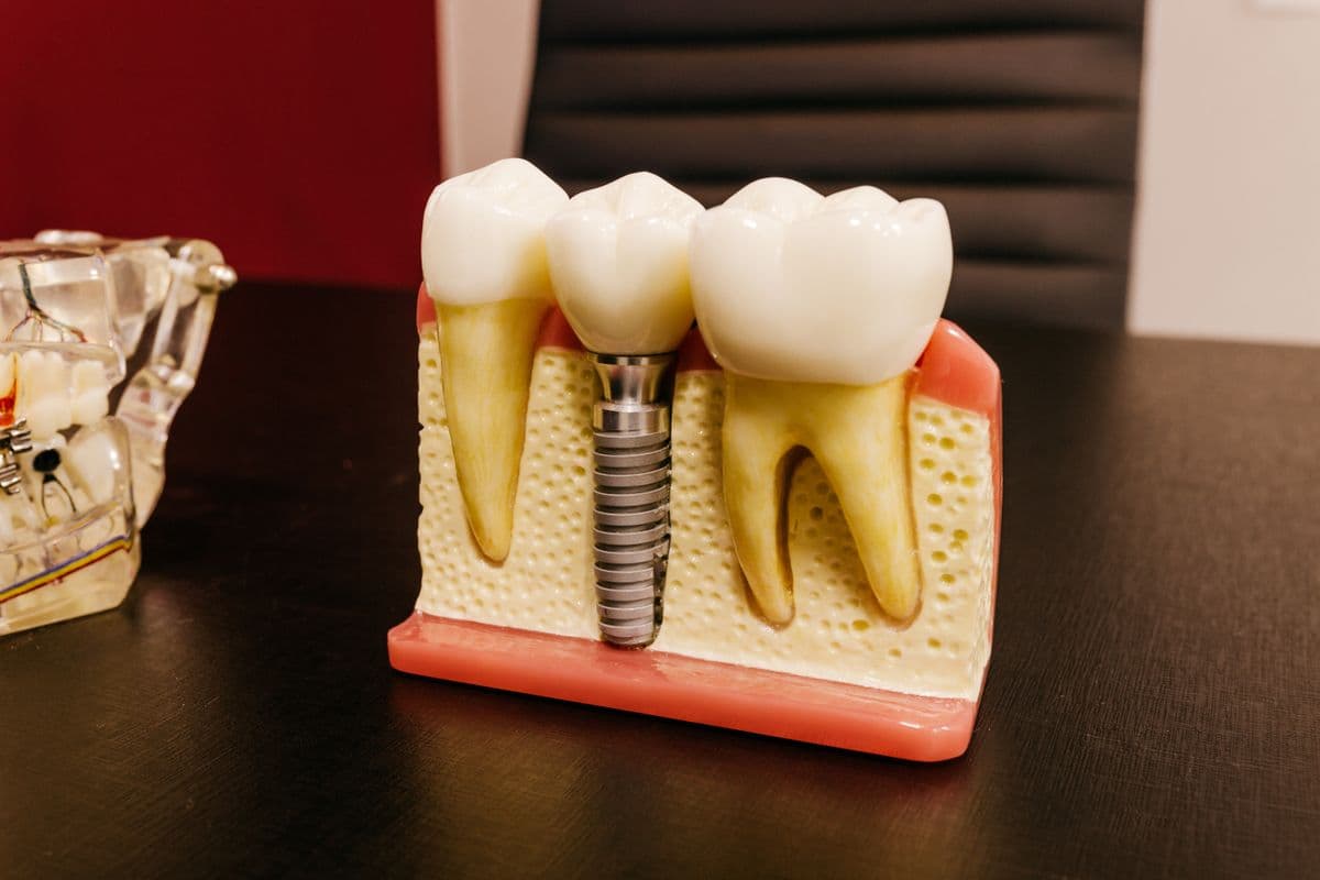 Quy trình trồng răng Implant chuẩn quốc tế