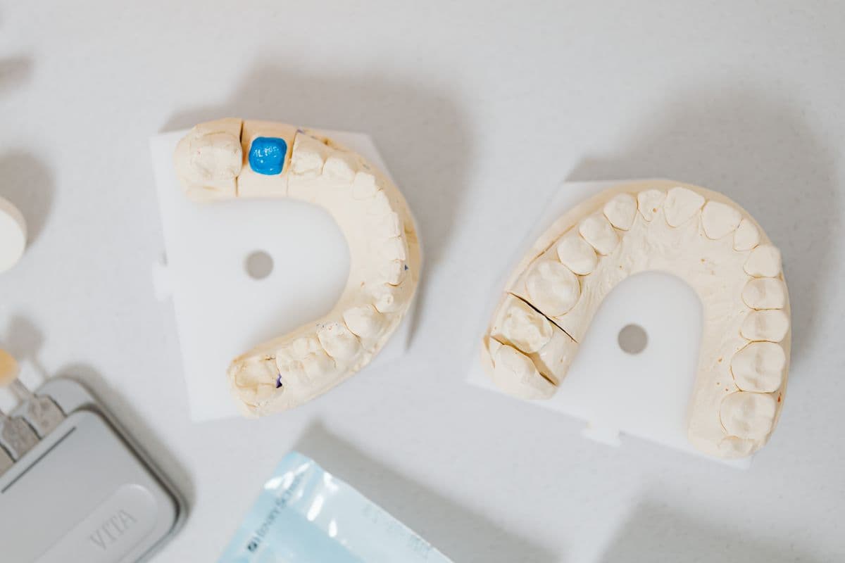 Răng sứ trên Implant khác gì răng sứ bọc thông thường?