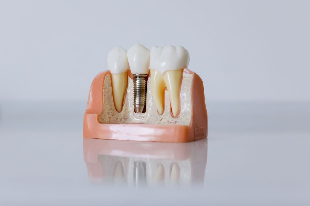 Trồng răng Implant là gì? Quy trình diễn ra như thế nào?
