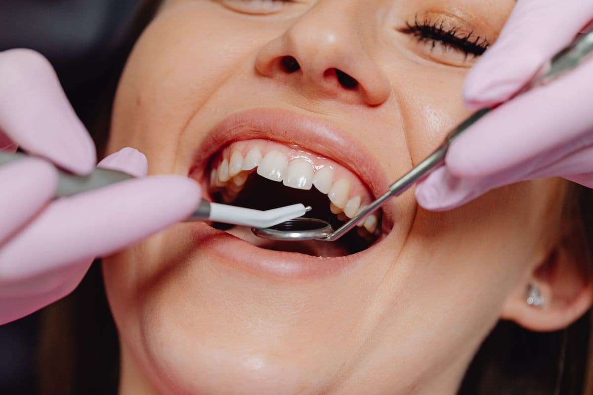 Viêm nướu, viêm nha chu: Dấu hiệu nhận biết sớm