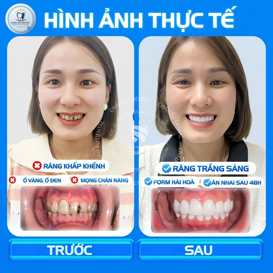 Bọc sứ — răng khấp khểnh, ố vàng