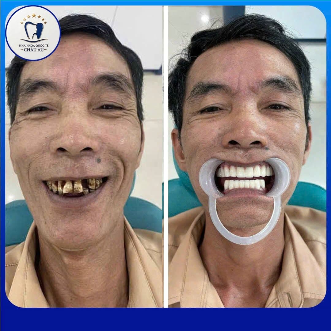 Bọc sứ — răng ố vàng, hư tổn