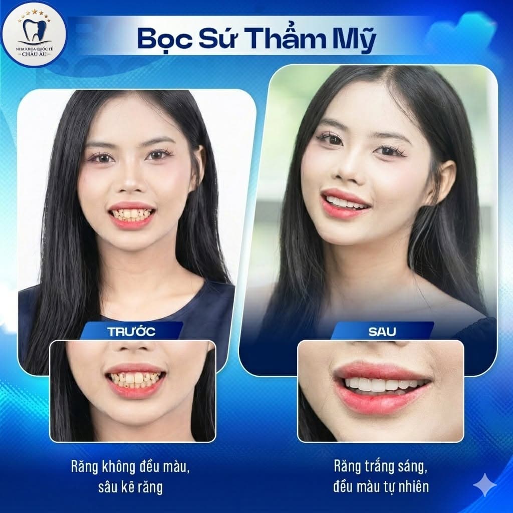 Bọc sứ thẩm mỹ