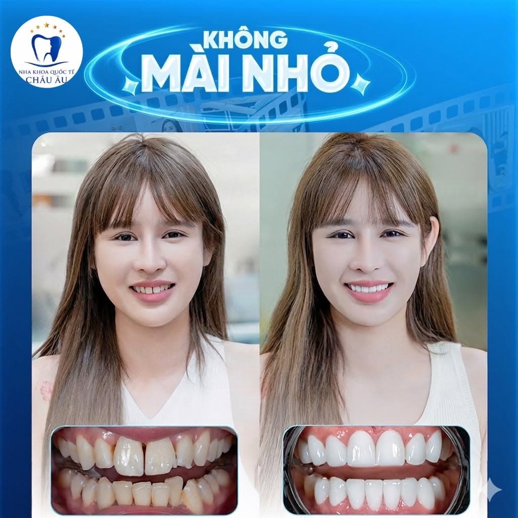 Dán sứ Veneer — không mài nhỏ