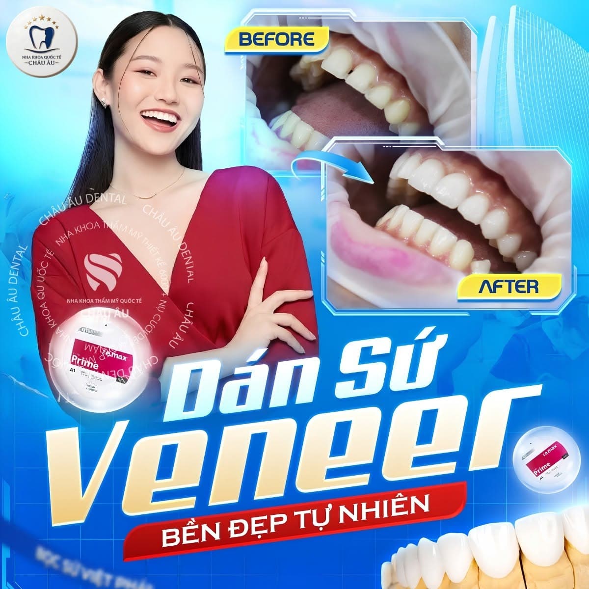 Dán sứ Veneer bền đẹp