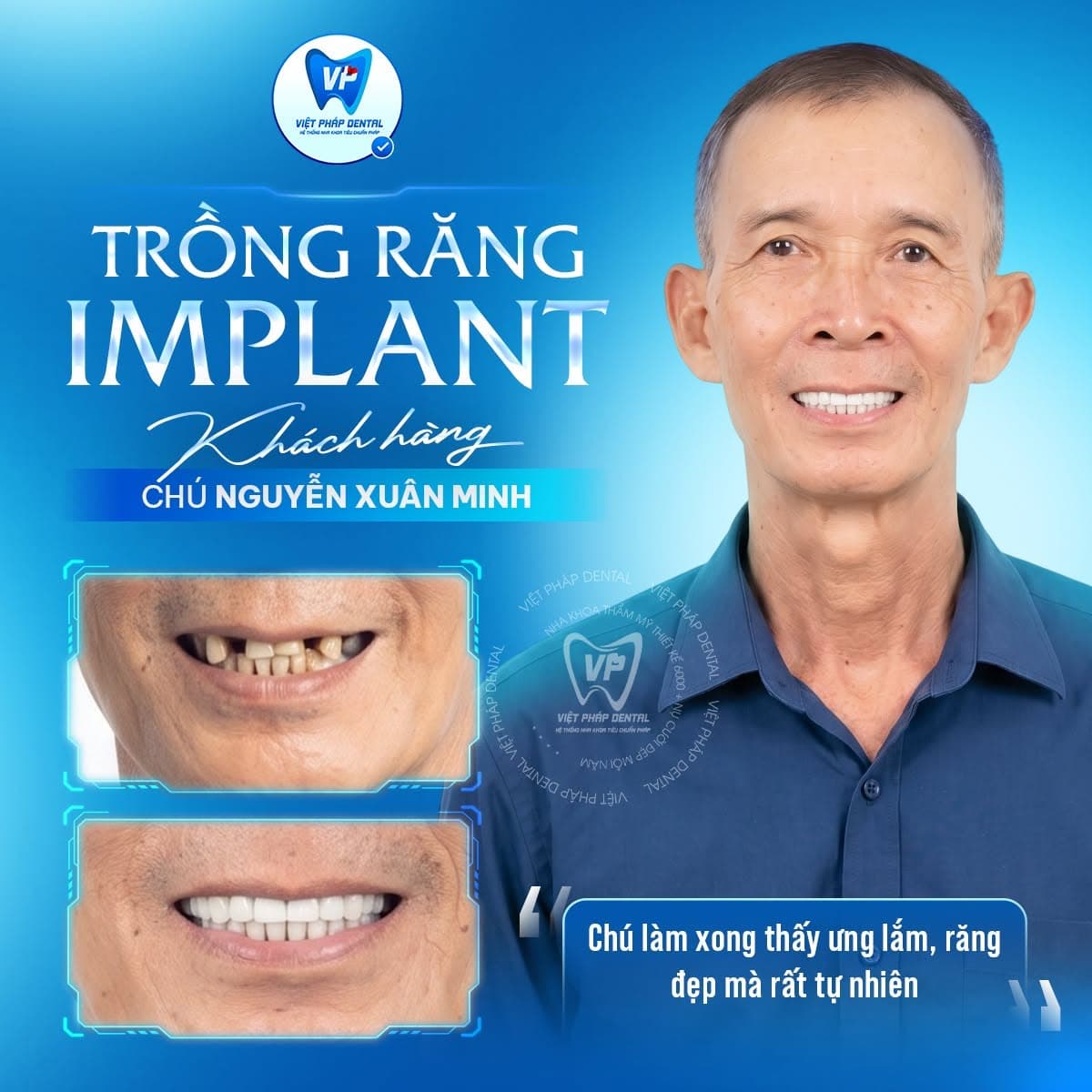 Trồng răng Implant